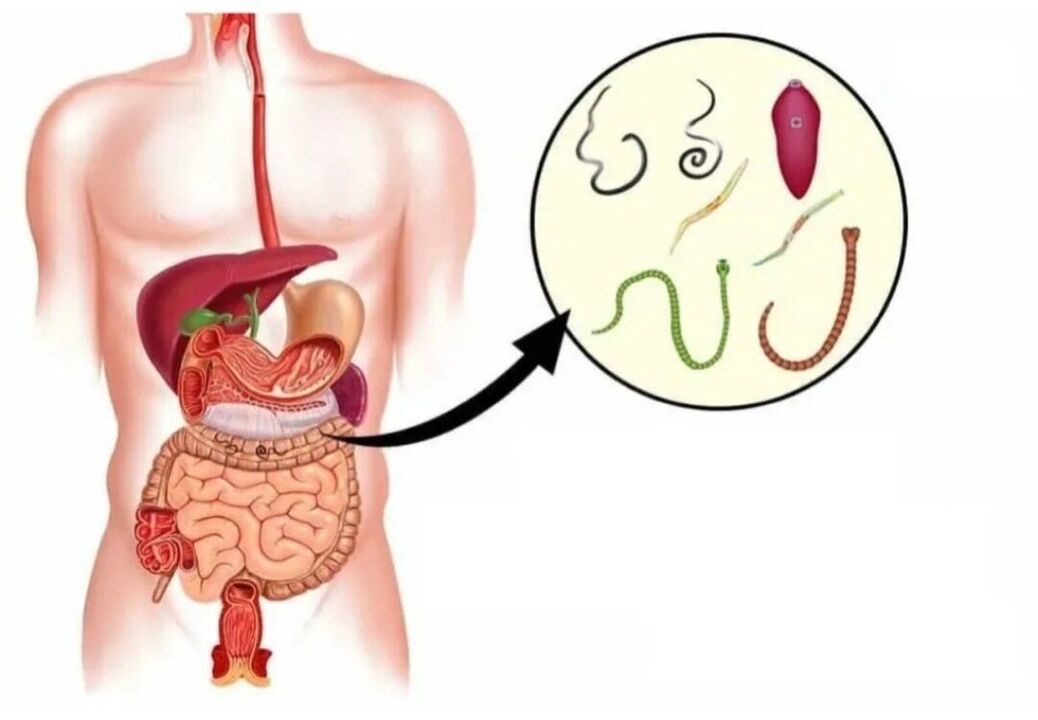 Parasiten a verschiddenen Organer