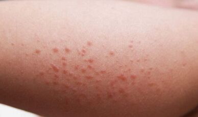 extern Manifestatiounen vun der Präsenz vu Parasiten am Kierper